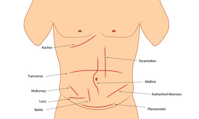 Abdominal Incision. Different types of abdominal incision. Surgery incision  