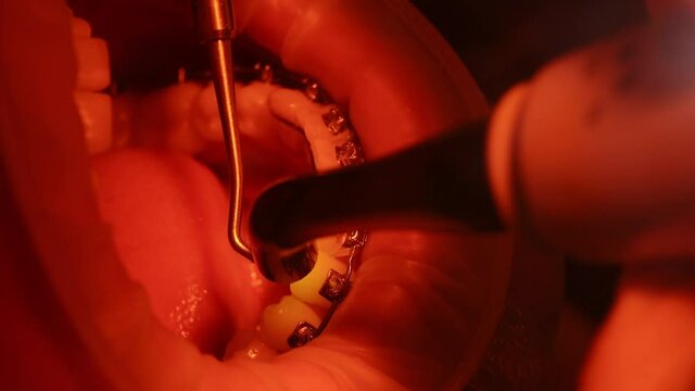 Bracket systems installation process. Patient in the dental chair. Modern orthodontics.