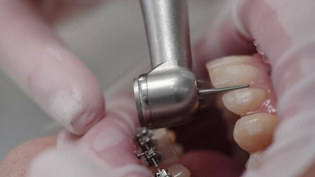 Process of removing braces. Teeth polishing. Patient in the dental chair. Modern orthodontics. Smooth beautiful teeth. Close up