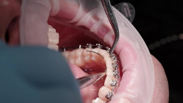 Bracket systems installation process. Patient in the dental chair. Modern orthodontics.