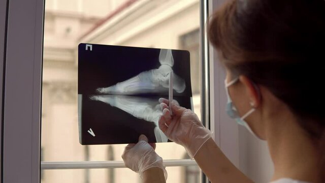 Doctor examines x-ray film of broken foot