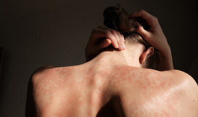 Close-up woman touches herself. Neck, back, spine. Psoriasis skin, eczema, rash and other skin...