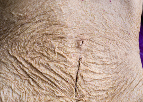 A close up shot of wrinkles on belly skin due to old age, Skin folds on an elderly female body.