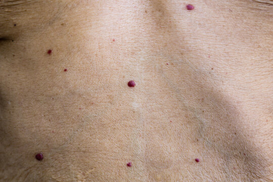 Red moles, or cherry angiomas, are common skin growths that can develop on most areas of your body. They’re also known as senile angiomas or Campbell de Morgan spots.