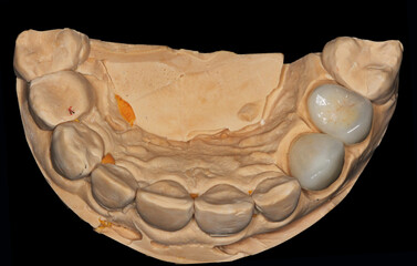 Naklejka premium Dental zirconia crowns in the plaster model