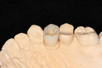 Dental veneers in the plaster model