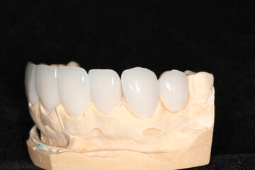 Dental veneers in the plaster model. smile makeover