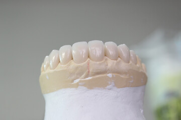 Dental veneers in the plaster model. smile makeover