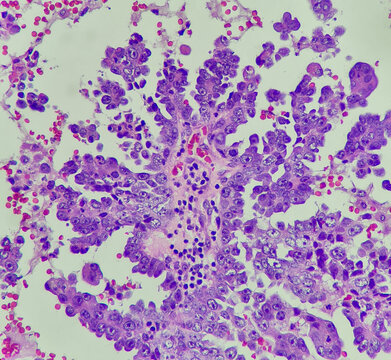 Photo of serous carcinoma of the ovary, showing papillary architecture, magnification 400x, photo under microscope