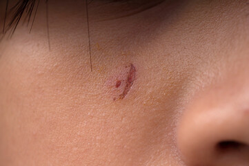 scabs of small wounds on teenage girl's face