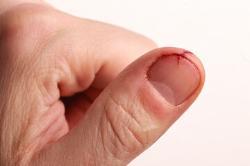 Knife cut injured, bleeding nail on a man's finger; color close up photo, No2.