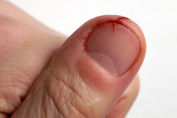 Knife cut injured, bleeding nail on a man's finger; color close up photo.