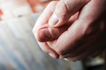 Guy Holding His Bitten Bleeding Thumb, Hands Have Dry Skin