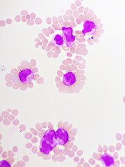 Acute promyelocytic leukemia cells or APL, analyze by microscope, original magnification 1000x