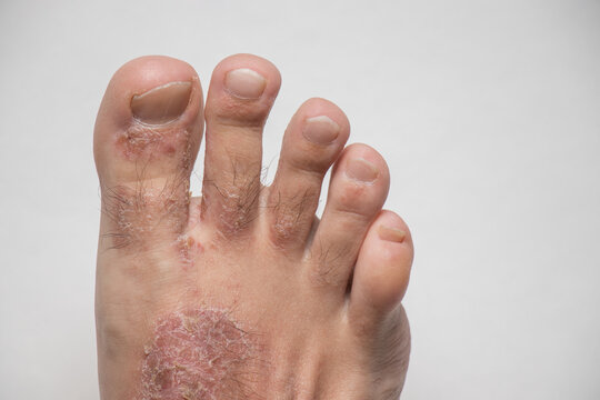 Close-up of leg. A person suffering from chronic psoriasis with the finger the inflamed part of the legs, on a white background. Allergy reaction.