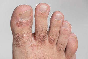 Close-up of leg. A person suffering from chronic psoriasis with the finger the inflamed part of the legs, on a white background. Allergy reaction.