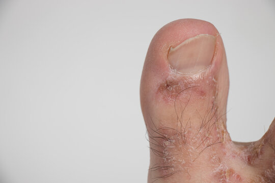Close-up of leg. A person suffering from chronic psoriasis with the finger the inflamed part of the legs, on a white background. Allergy reaction.
