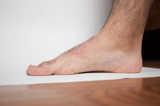 Close-up of leg. A person suffering from chronic psoriasis with the finger the inflamed part of the legs, on a white background. Allergy reaction.