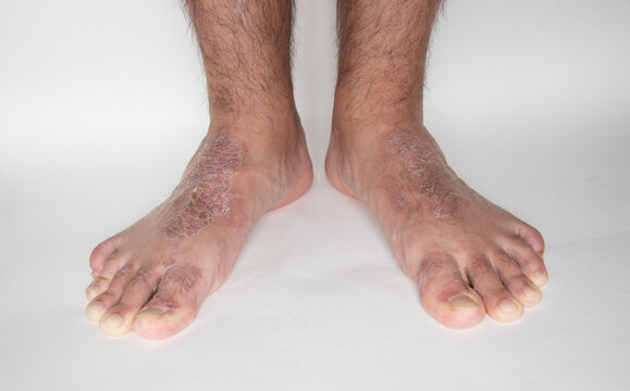 Close-up of leg. A person suffering from chronic psoriasis with the finger the inflamed part of the legs, on a white background. Allergy reaction.