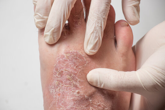A dermatologist examines a leg affected by a fungus. Treatment of mycosis and assistance to patients with fungal diseases. Mycotic eczema of the legs, on a white background.
