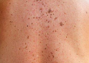 Fototapeta premium Close-up detail of a man's back showing bare skin with scattered moles and freckles, melanoma. Pigmentation. Birthmarks on skin, Possible benign moles , effects of the sun on the skin.