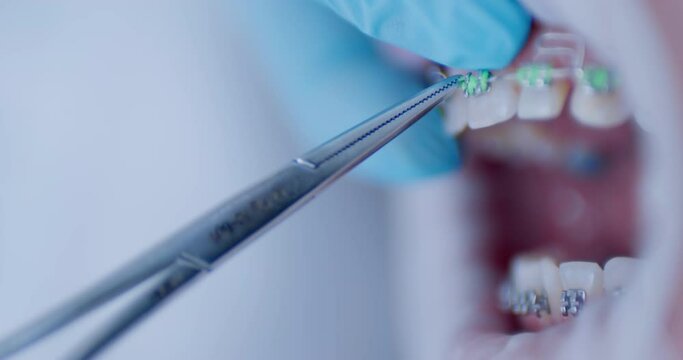 Close-up open mouth with braces and orthodontist hand in blue gloves using dental forceps while putting green ligature ties on braces. The patient is having orthodontic treatment.