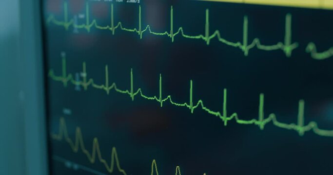 Close-up patient's monitor screen with diagrams: electrocardiogram, pulse oxygen saturation, non-invasive blood pressure.