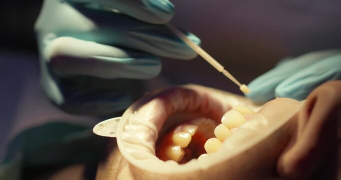 Close-up a male patient is laying in the dental chair with an optragate while the dentist's hand is smearing the patient&rsquo;s upper teeth by using a plastic stick with liquid.