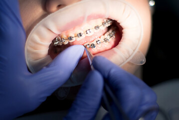 Dental manipulation with braces
