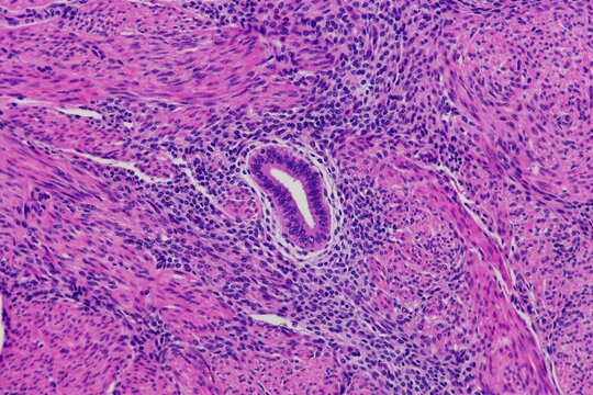 Endometrial gland and stroma surrounded by muscle in a painful condition called adenomyosis of the uterus. Actual microscopic photograph.