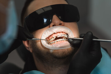 Installing or adjusting braces to correct bite. Male dentist examines the braces. Top view, close-up
