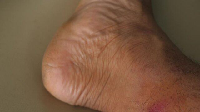 Skin disease, which is caused by allergic ulcers, canker sores or blisters on the legs.