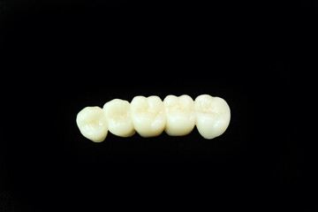 Zirconia bridge with all porcelain baked