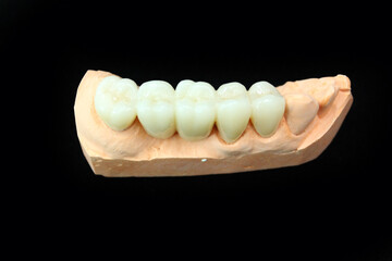 Zirconia bridge with all porcelain baked