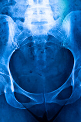 Hips pelvis xray scan