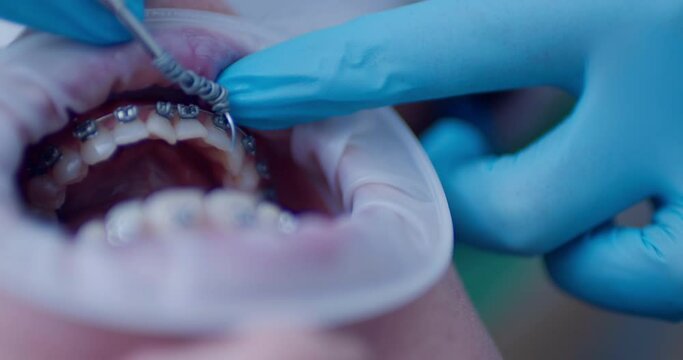 Close-up open mouth with optragate and on the teeth is a bracket system and a medical hand is taking out a metal archwire from the lower jaw with the braces by using a dental probe.