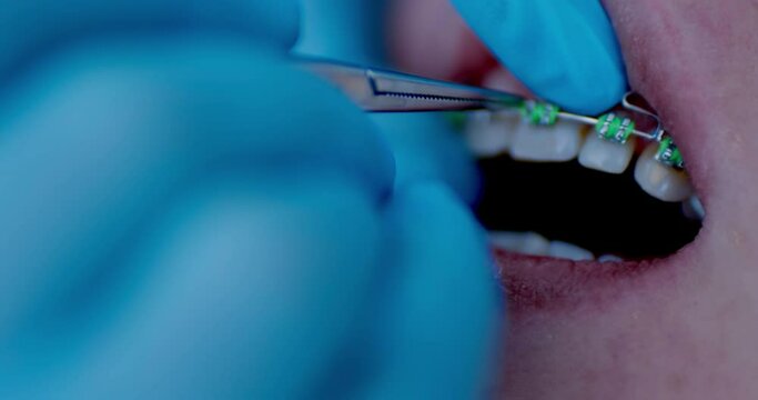 Close-up an orthodontist hand in blue gloves using dental forceps while putting green ligature ties on braces. The patient is having orthodontic treatment.