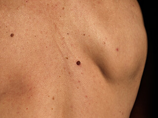 Naklejka premium Growing red mole on man's back. Skin cancer symptom