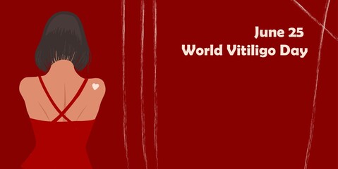 June 25 - World Vitiligo Day. Pigmentation disorders. Skin depigmentation. Vector illustration on the theme of rare diseases. Chronic skin disease