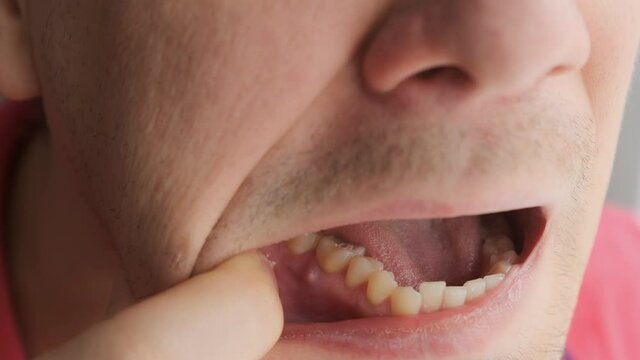 Man is showing tooth in mouth with a dental abscess fistula on gum, closeup view. Tooth with a temporary filling seal. Caries dental concept. Dental treatment of the internal parts of the tooth.