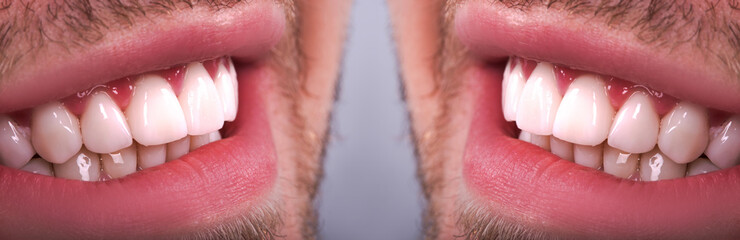 Perfect Close Up White beautiful Veneers Teeth bleaching crowns whitening young lady smiling, Male...