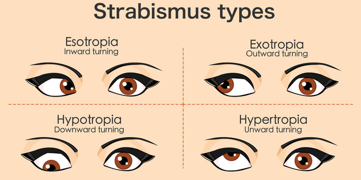 Strabismus types woman crossed eyes. Esotropia,  inward turning, Outward, exotropia, Upward hypertropia, Downward hypotropia, Skin color background. Vector illustration