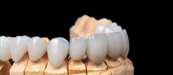 press ceramic crowns and veneers b2 color