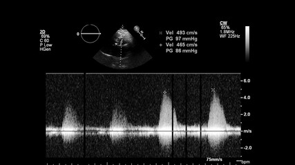 Image of the heart in gray-scale mode during transesophageal ultrasound.