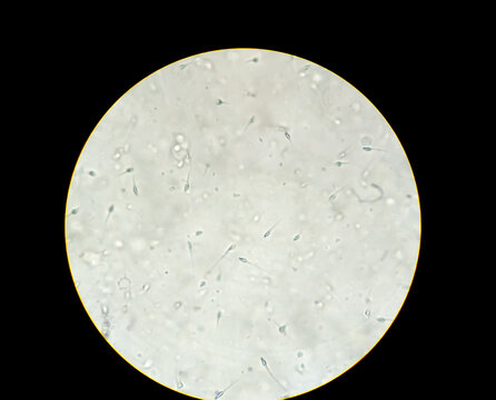 Semen analysis, sperm analysis on microscopic examination. Micrograph of Oligospermia