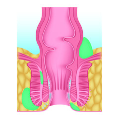 Anorectal abscess. Swelling near the anus. Inflammation of the anus and rectum. Disease of the glands. Accumulation of pus. Anatomy diagram of the anus. Vector illustration