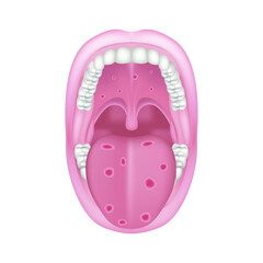 Oral syphilis. Venereal disease. Ulcers on the tongue and palate. Vector illustration