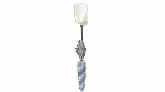 Ceramic crown, custom implant abutment and implantat instalation process. Medically accurate 3D animation.
