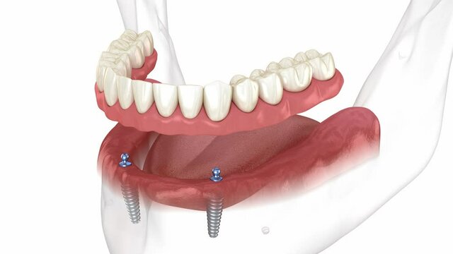 Mandibular removable prosthesis All on 2 system supported by implants with ball attachments. Medically accurate dental 3D animation