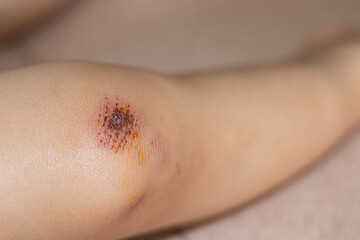 Abrasions on children's knees caused by a fall.